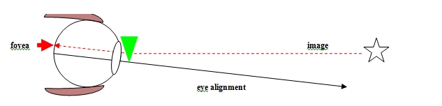 Diagram 4 - BVD - Visual description of Binocular Vision disorder