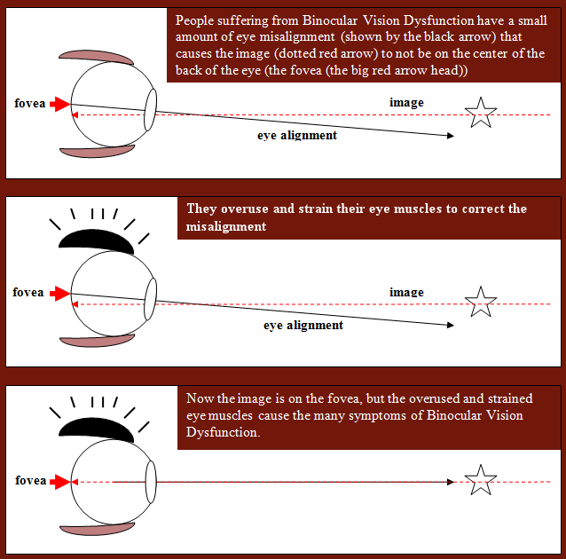 binocular vision dysfunction test